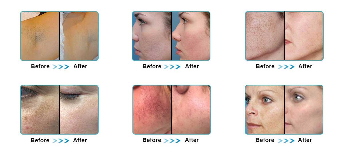 Professional IPL+Elight+SHR Fast Hair Removal Beauty Equipment Professional IPL+Elight+SHR Fast Hair Removal Beauty Equipment