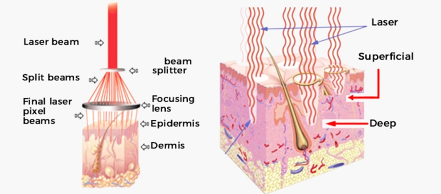Understanding the Role of Medical Fractional CO2 Laser Machines in Skin Whitening