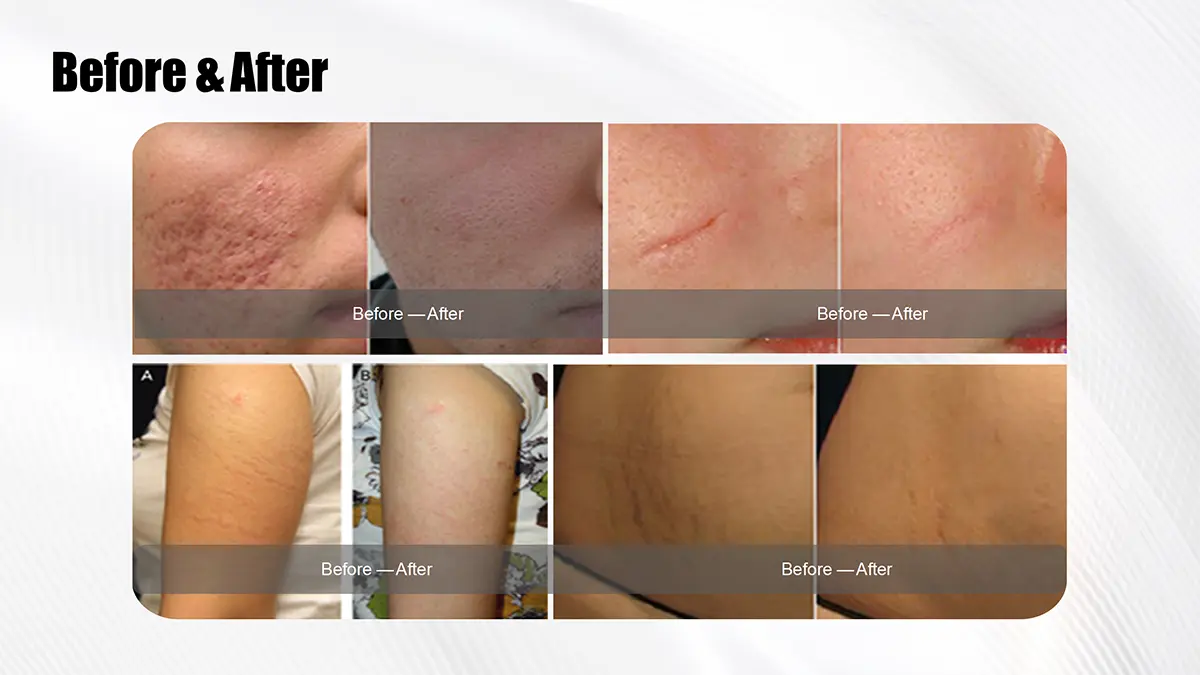 Fractional CO2 Laser Scar Removal Before And After Results SANHE LASER