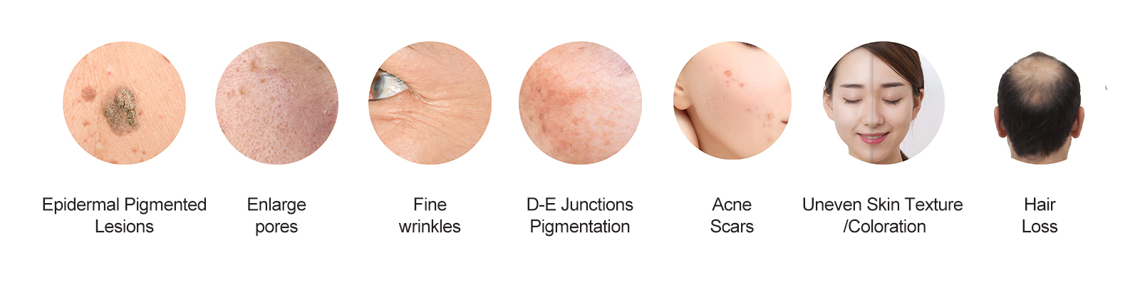 Application-of-LumiGlam-Pro-1927+1550nm-Fractional-Laser-Machine Application-of-LumiGlam-Pro-1927+1550nm-Fractional-Laser-Machine