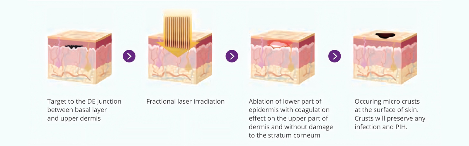 Therapeutic-Mechanism-of-LumiGlam-Pro-1927+1550nm-Fractional-Laser-Machine Therapeutic-Mechanism-of-LumiGlam-Pro-1927+1550nm-Fractional-Laser-Machine