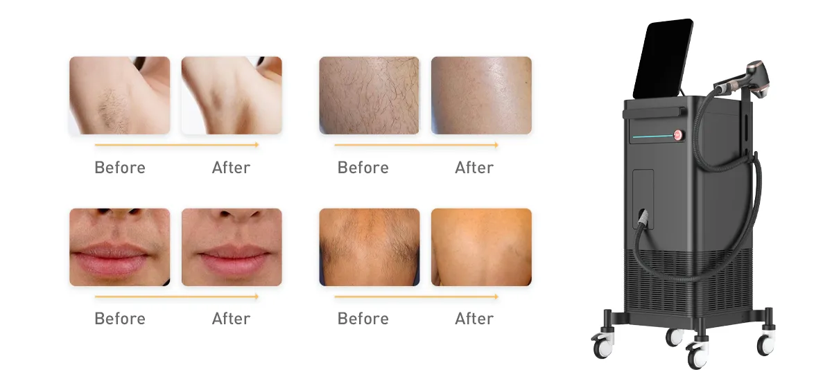 How to Choose a Reliable Diode Laser Hair Removal Machine Supplier