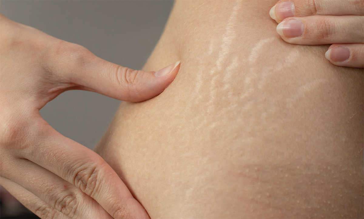 Cellulite.jpg Cellulite.jpg