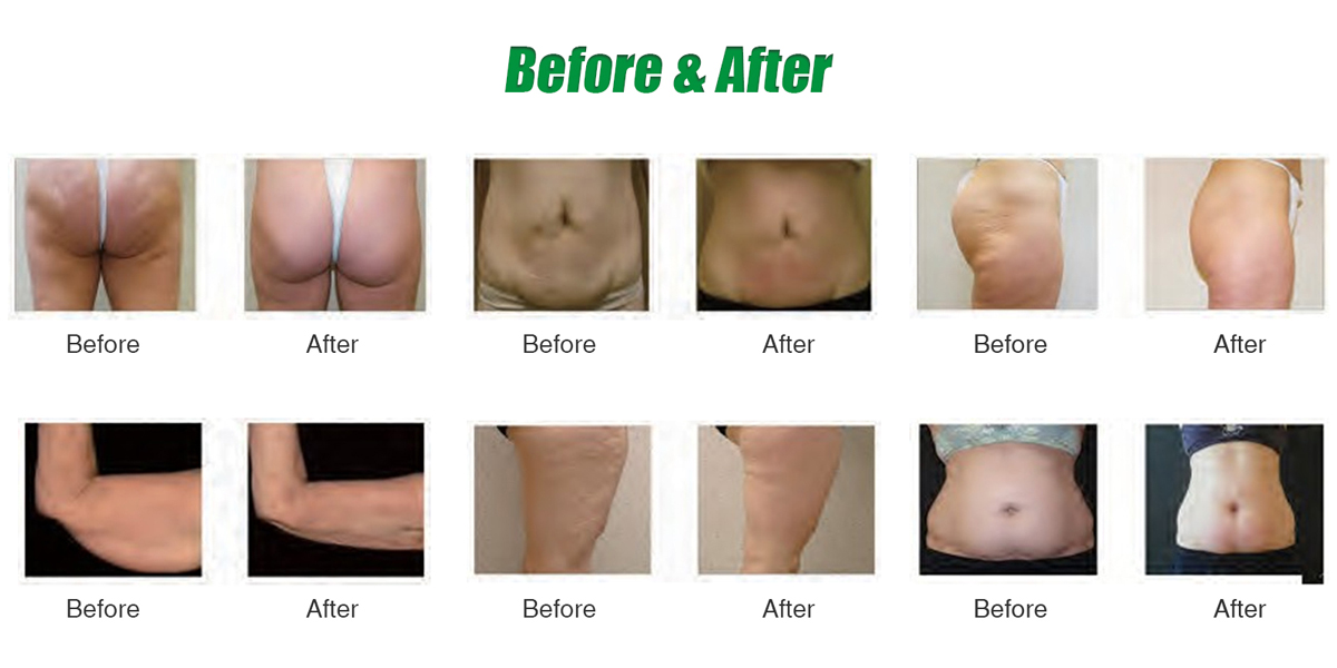 Velashape roller body slimming machine