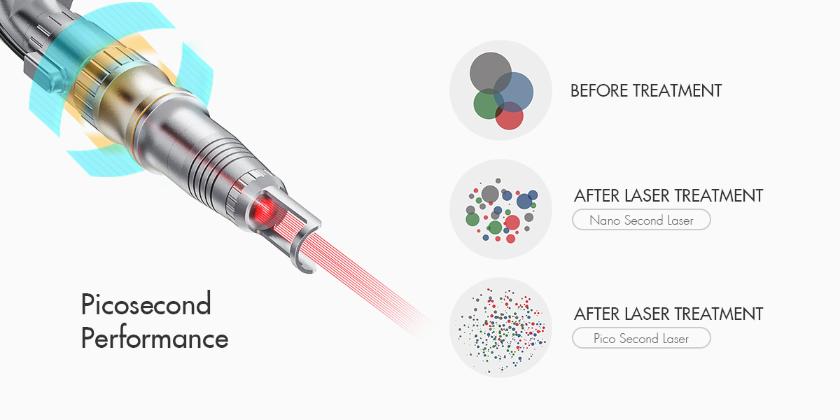 tattoo removal equipment