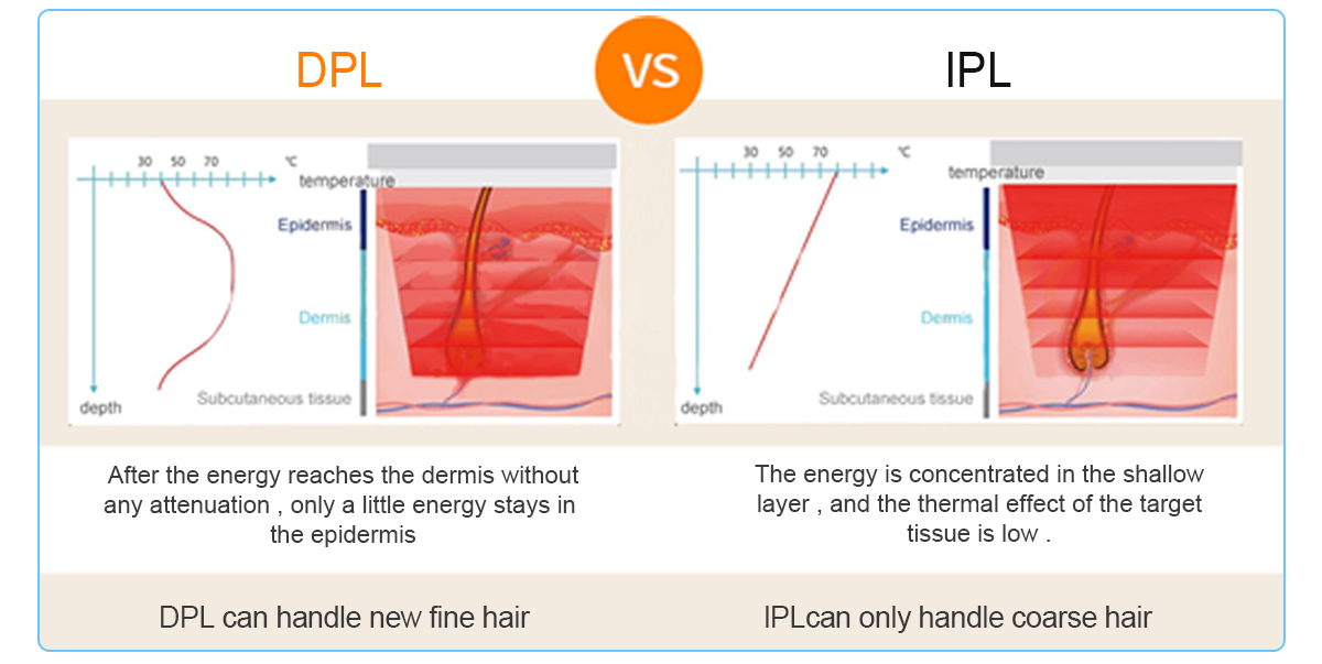 What's the Difference Between DPL and IPL?