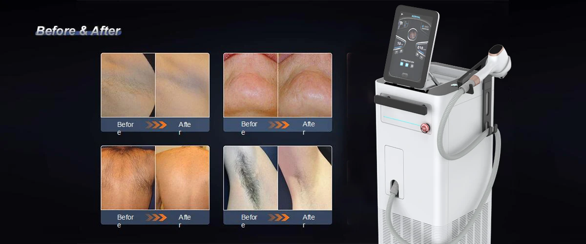 laser medical diode ice laser.jpg laser medical diode ice laser.jpg
